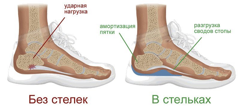 Ортопедические стельки польза
